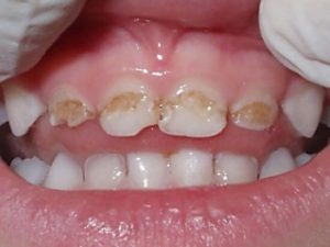 формы заболевания зубов у детей - эрозивная гипоплазия эмали